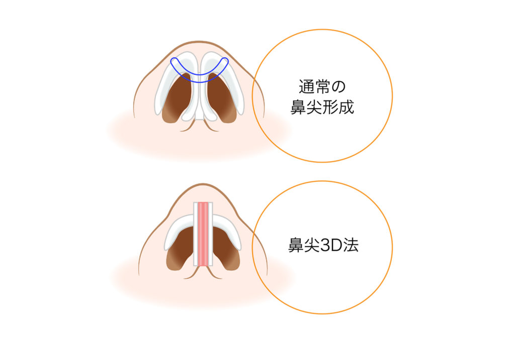 だんご鼻の原因