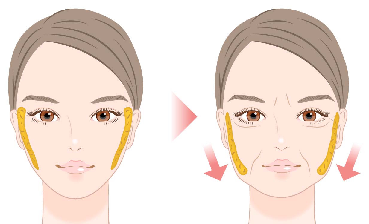 バッカルファット