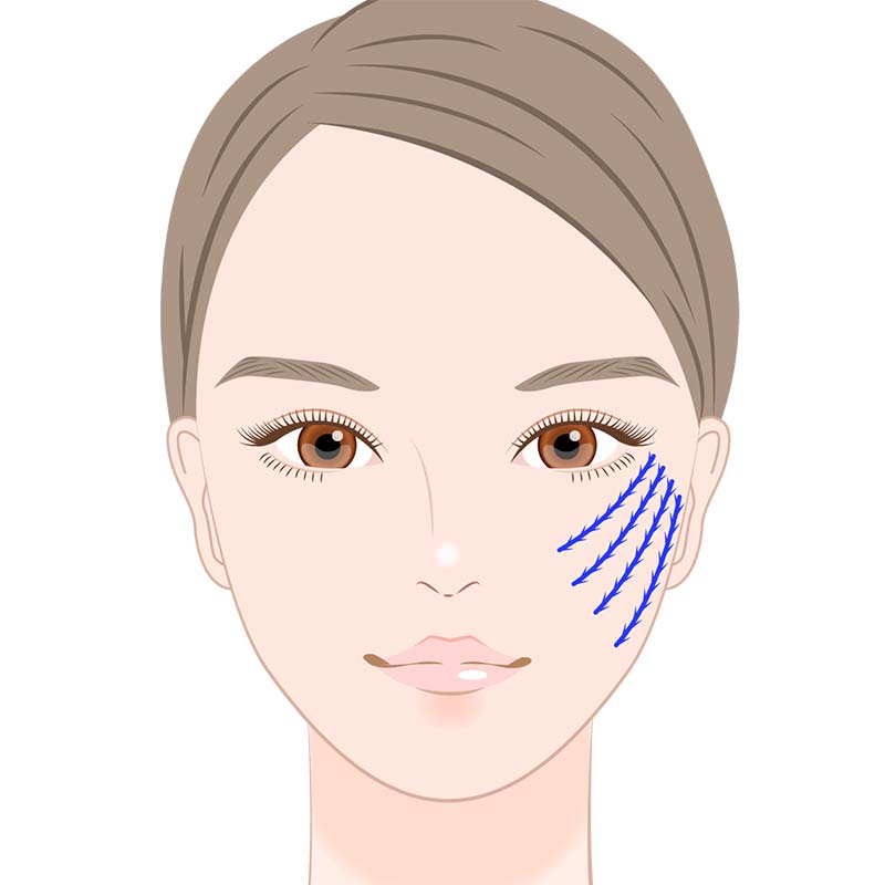 クイーンリフト