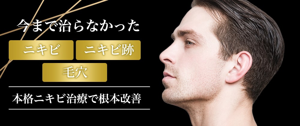 ニキビ治療