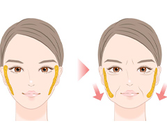 バッカルファット