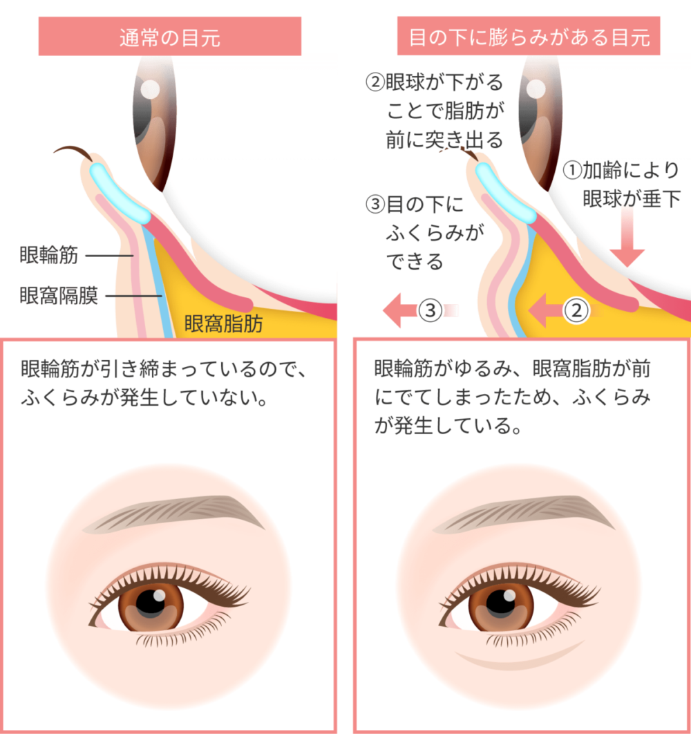 目の下 クマ 取る 方法