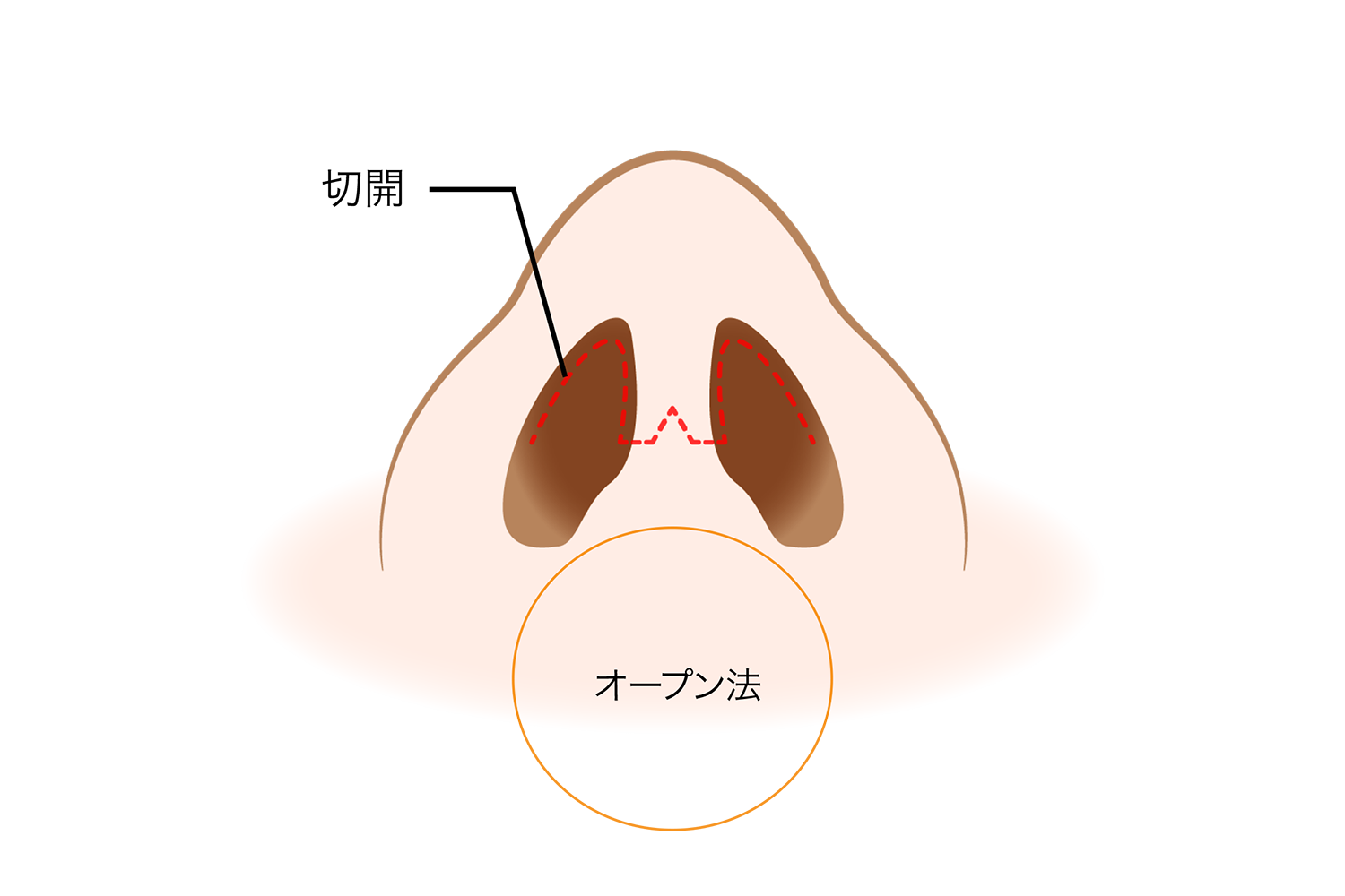 　　　　　　　軟骨採取部位 ：耳介軟骨 ・耳珠軟骨