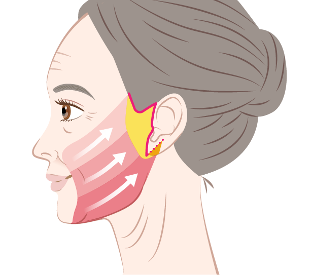 フェイスリフト・ネックリフト